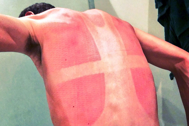 Sunburn - Terbakar matahari karena jersey yang tidak optimal